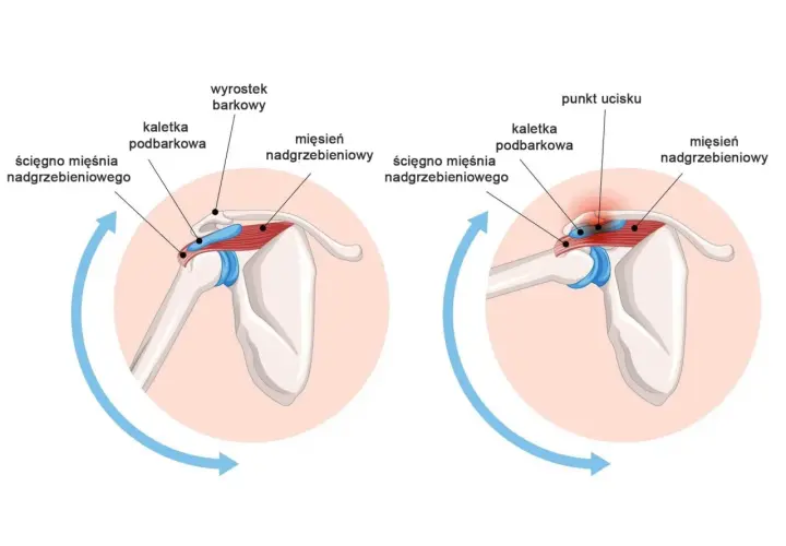 Anatomia barku: ścięgno mięśnia nadgrzebieniowego, kaletka podbarkowa i wyrostek barkowy. Po prawej widoczny punkt ucisku.