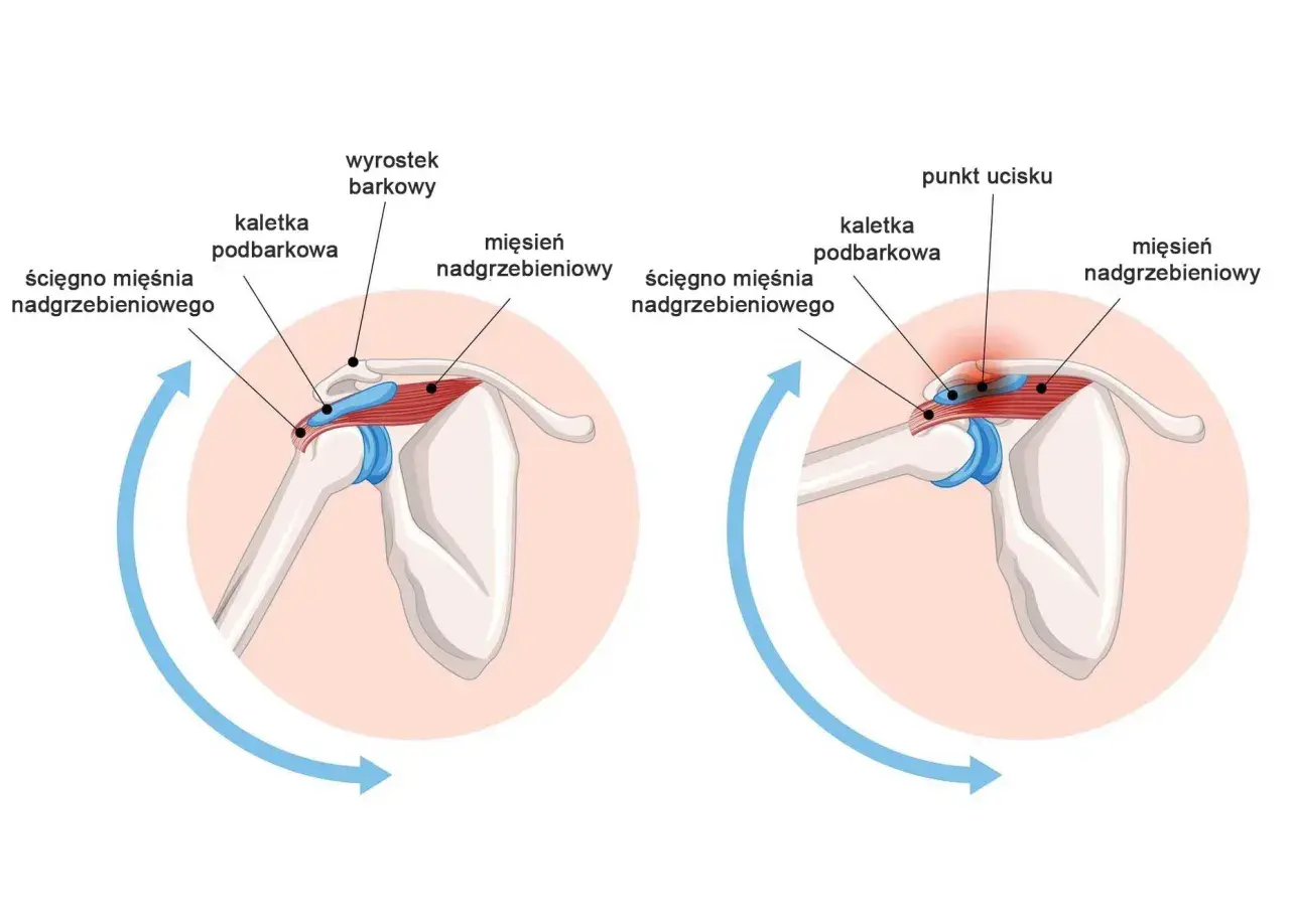 Anatomia barku: ścięgno mięśnia nadgrzebieniowego, kaletka podbarkowa i wyrostek barkowy. Po prawej widoczny punkt ucisku.